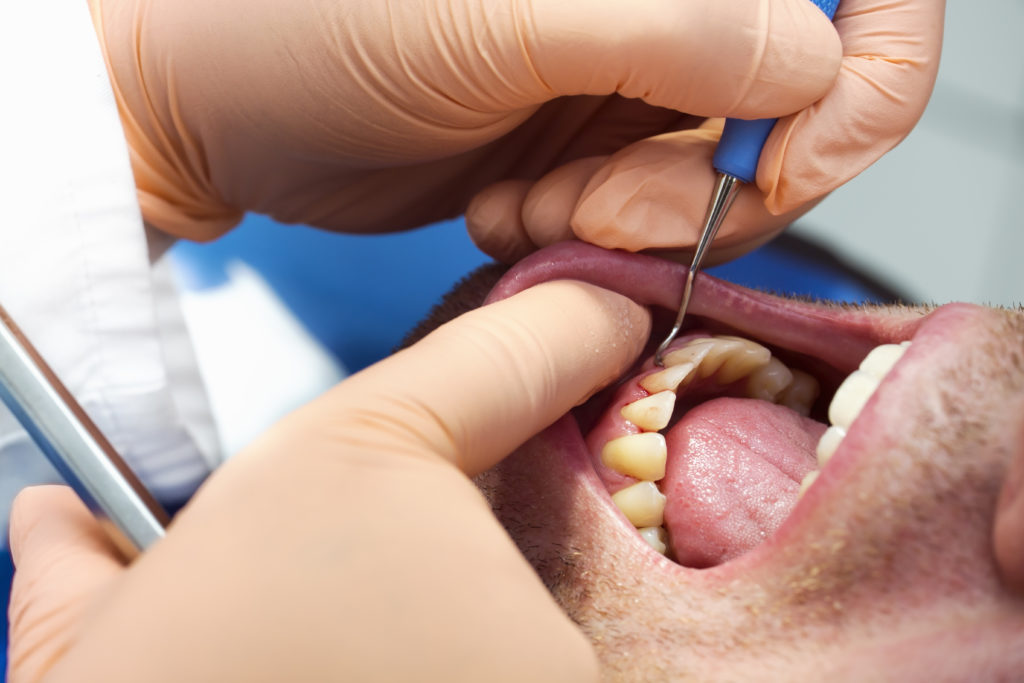Parodontite e chirurgia parodontale rigenerativa: per saperne di più!