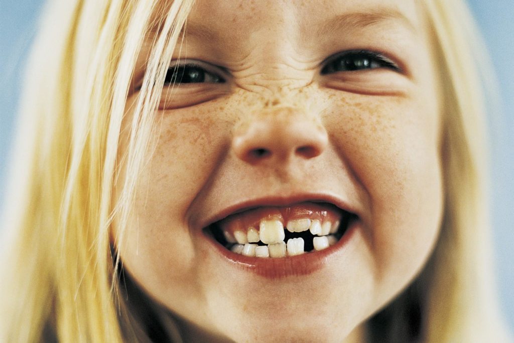 Apparecchio denti per bambini! Ecco quello che serve sapere!