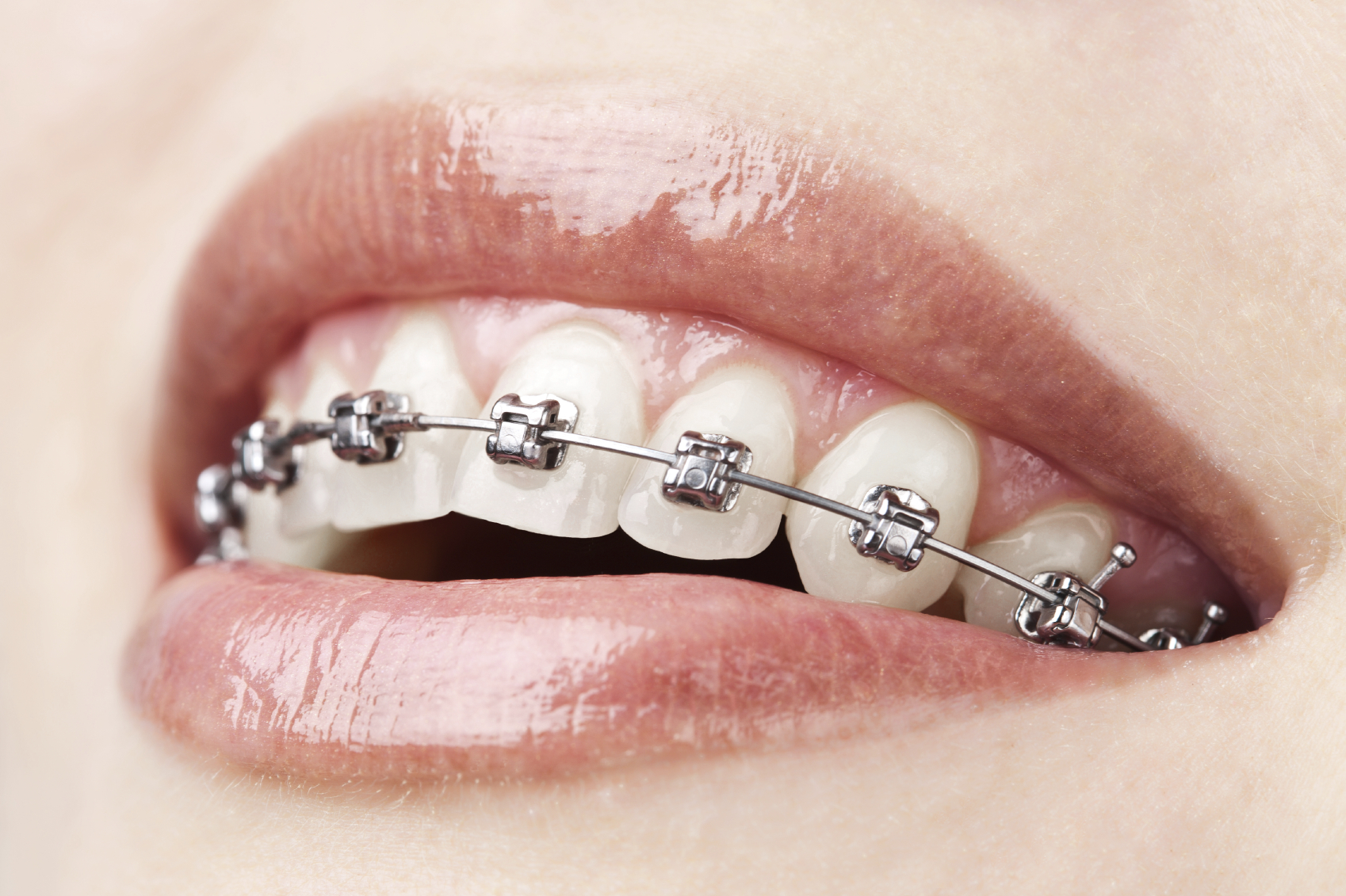 Apparecchio ortodontico: come e quando è necessario!