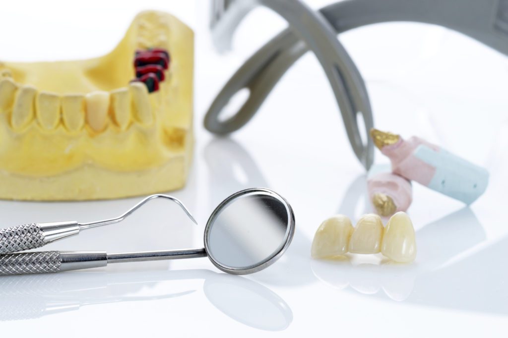 Implantologia dentale: ecco cosa serve sapere!