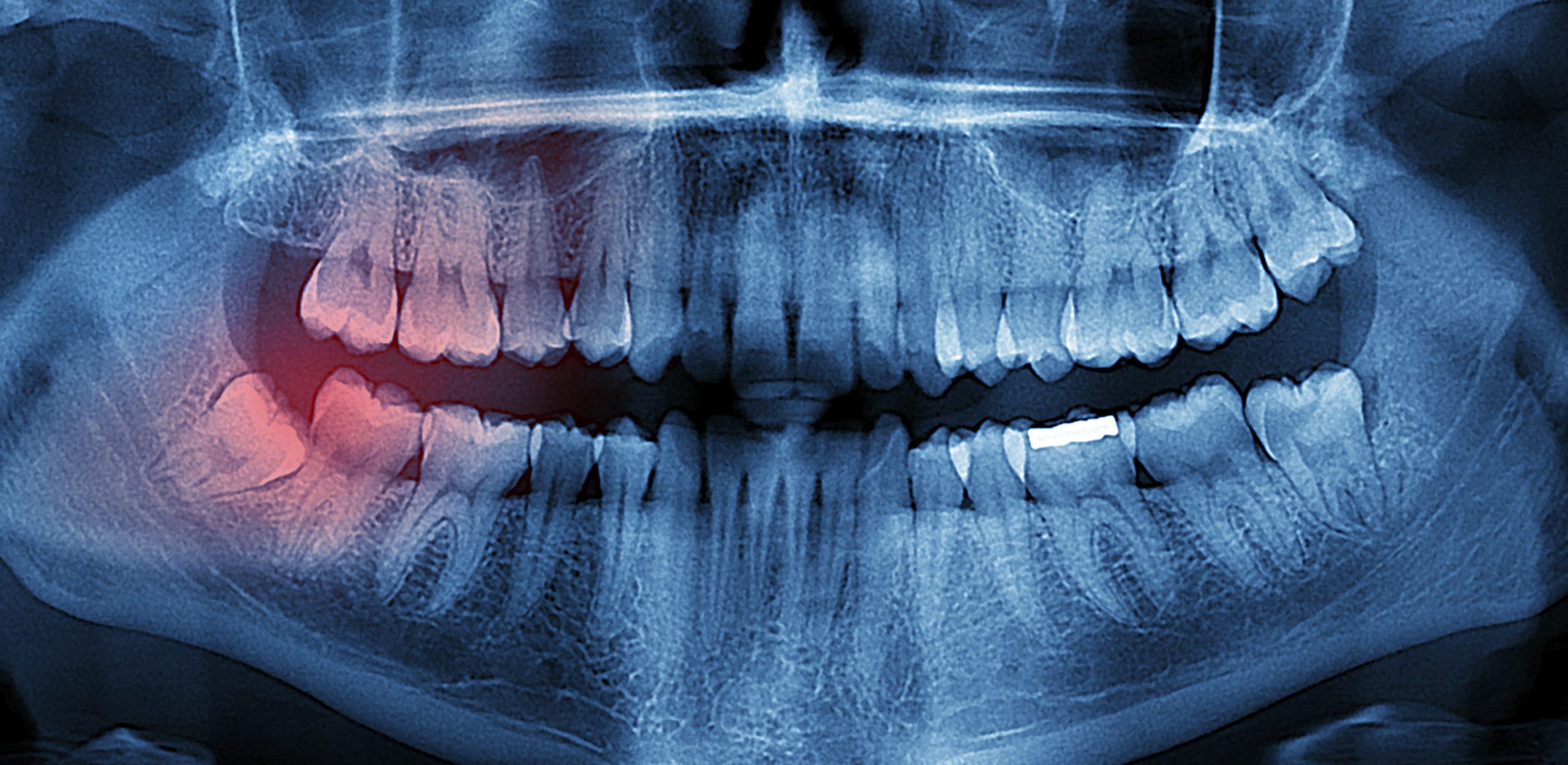 Radiografia endorale: tutto quello che serve sapere!