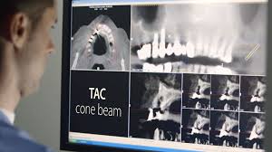 TC CONE BEAM: L’importanza nella cura dei denti dei bambini!